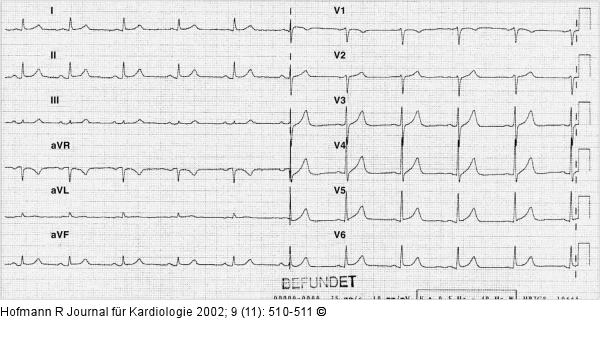 Mobiler Thrombus in der RCA bei NSTEMI