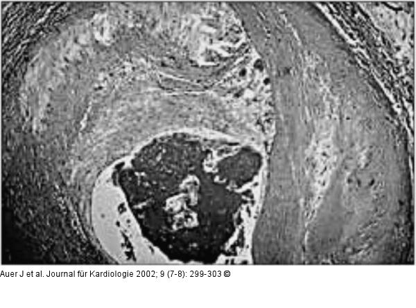 Akute Koronarsyndrome - Thrombusbildung - Plättchenaggregation