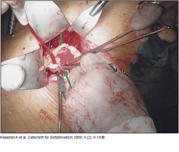 Aneurysma