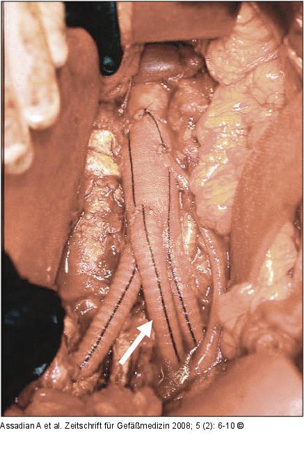 Trifurkationsprothese