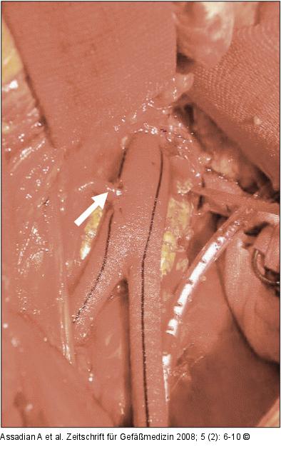 Prothese - A. mensenterica inferior 