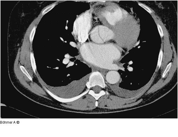 Aorta-Dissektionsmembran