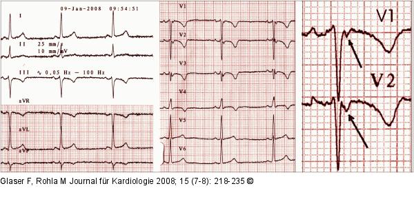 QRS-Komplex
