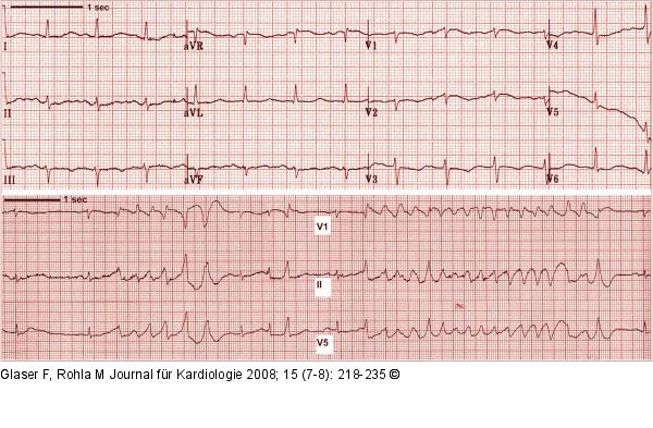 QT-Intervall