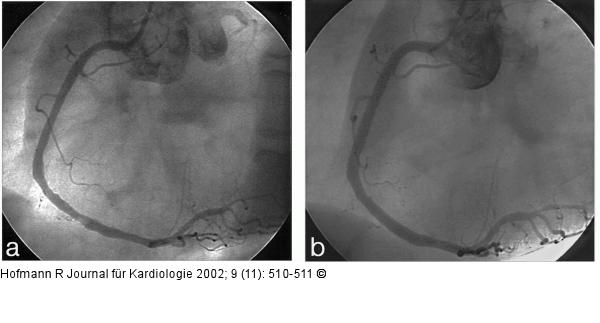 Mobiler Thrombus der RCA bei NSTEMI