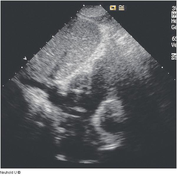  Vena cava inferior