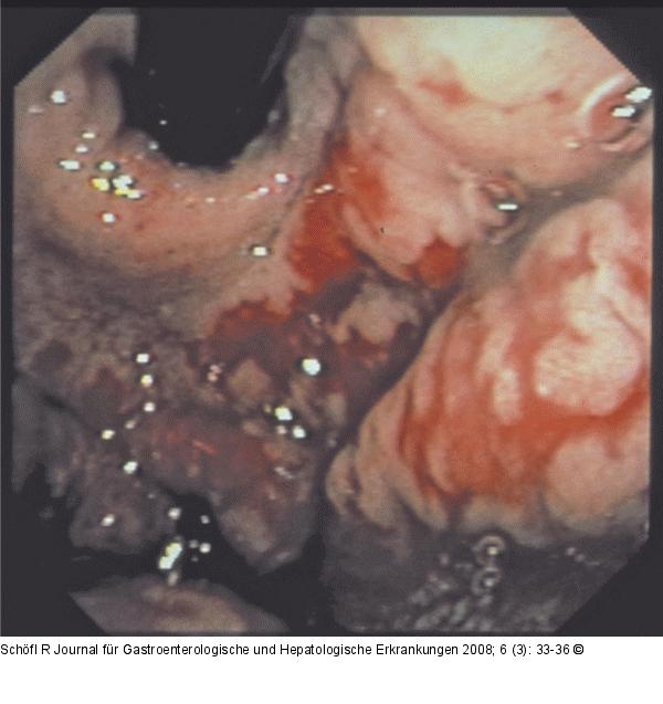Gastritis