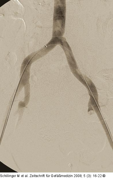 Morbus embolicus