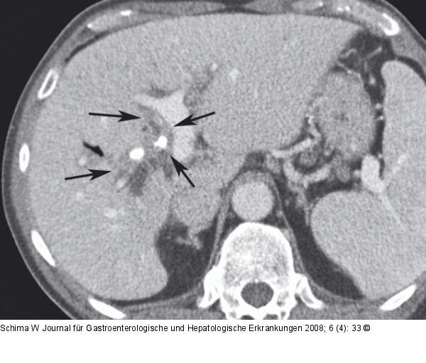 Hypodenser Tumor