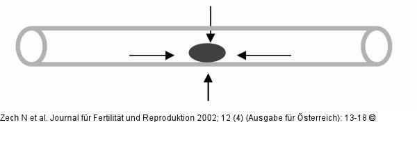 Straw - Kälteverteilung
