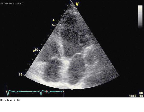 Sinus coronarius