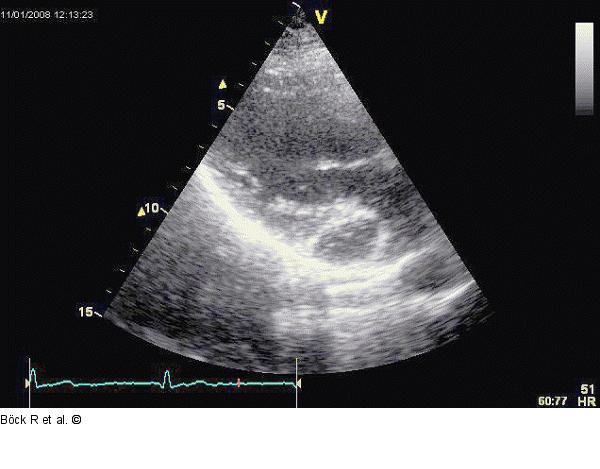 Sinus coronarius