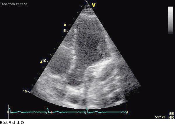 Sinus coronarius