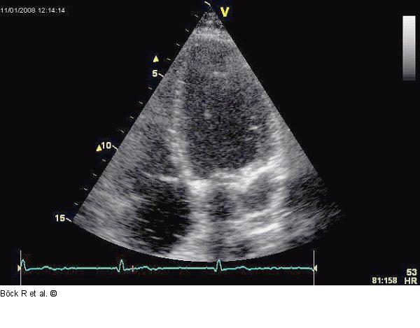 Sinus coronarius