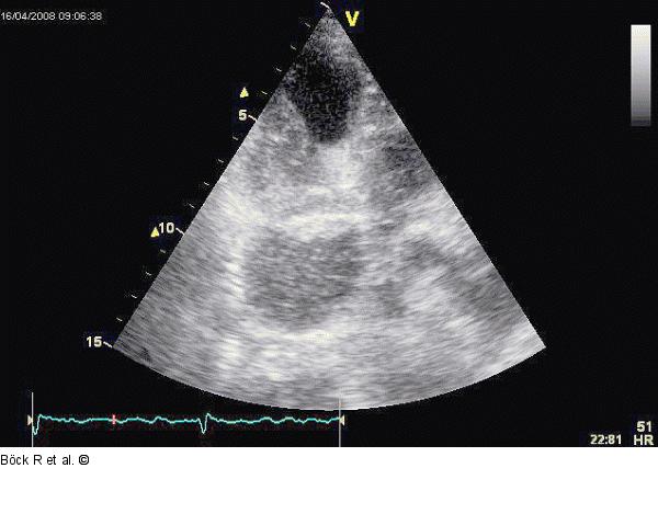 Sinus coronarius