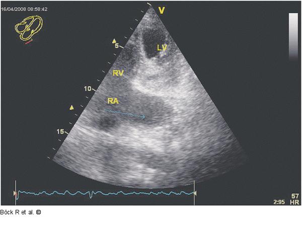 Sinus coronarius