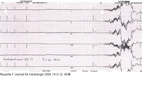 EKG