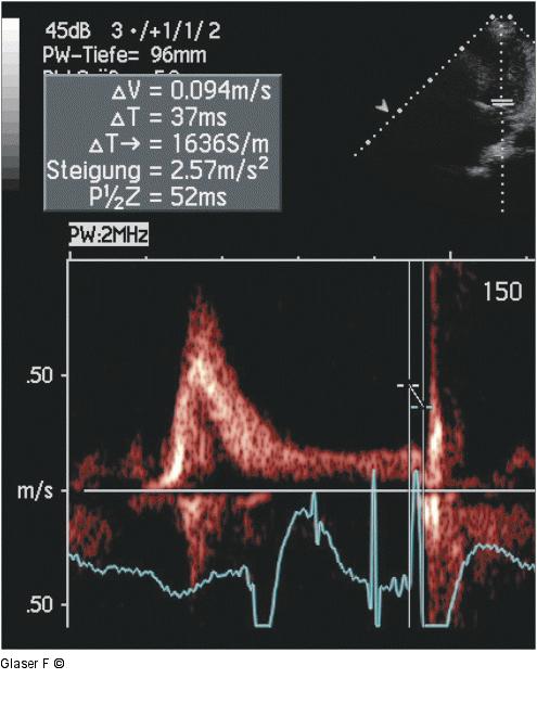 Gepulster Doppler