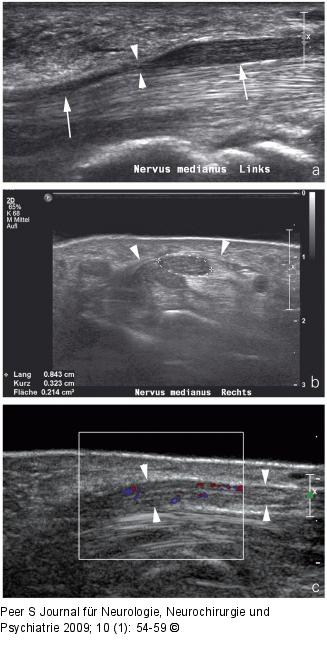 Neruvs medianus