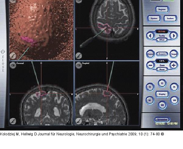 Neuronavigation