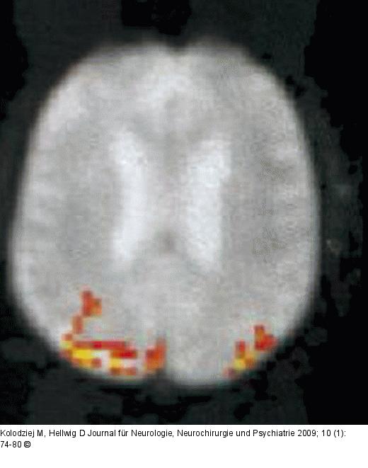Motorcortex