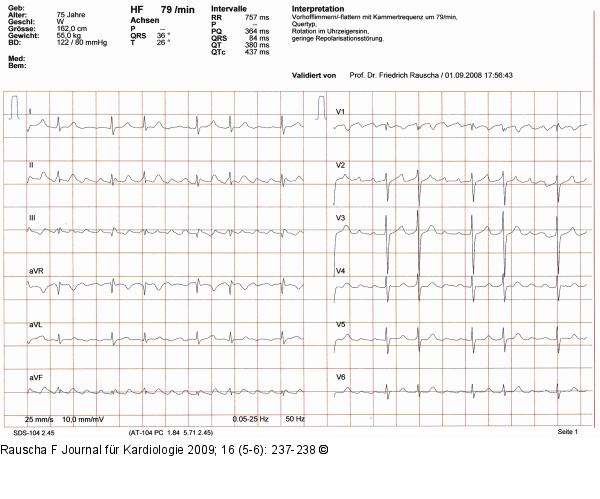 EKG