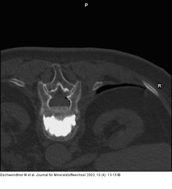 Vertebroplastie