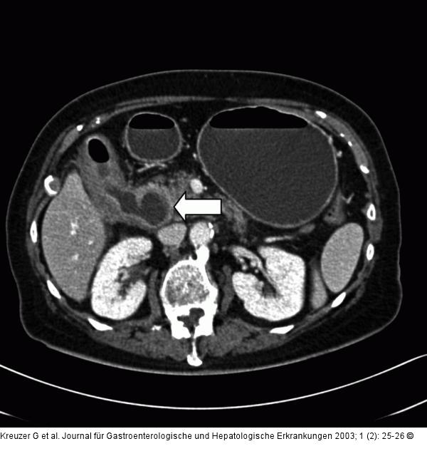 CT- Cholezystis