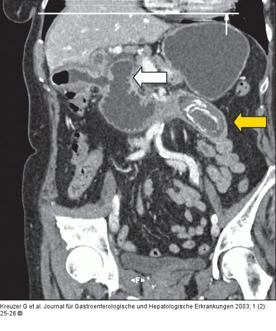 CT-Cholezystis - Ileus