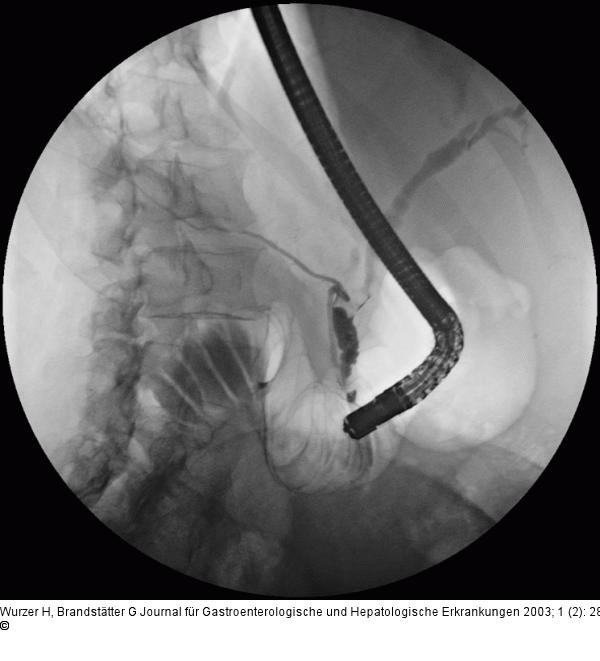 Ductus choledochus - Mirizzi-Syndrom
