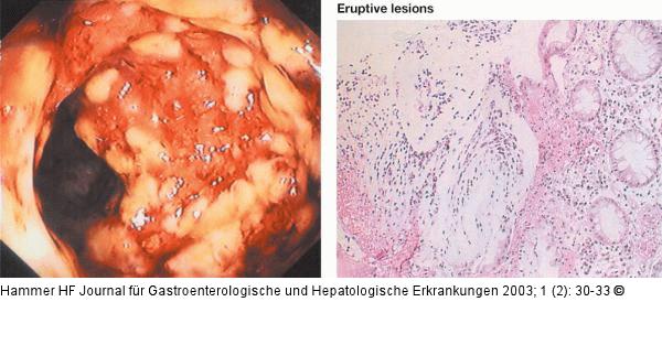 Pseudomembranöse Kolitis