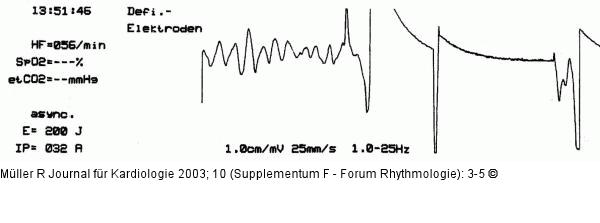 CPR-Verlauf  - EKG