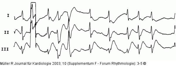 CPR-Verlauf - EKG
