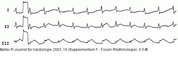 CPR-Verlauf - EKG