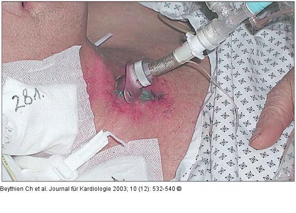 Chirurgische Tracheotomie - Trachealkanüle