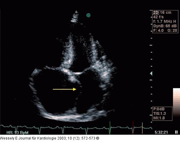 Pulmonale Hypertonie
