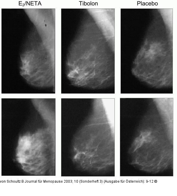 HRT- Mammogramm
