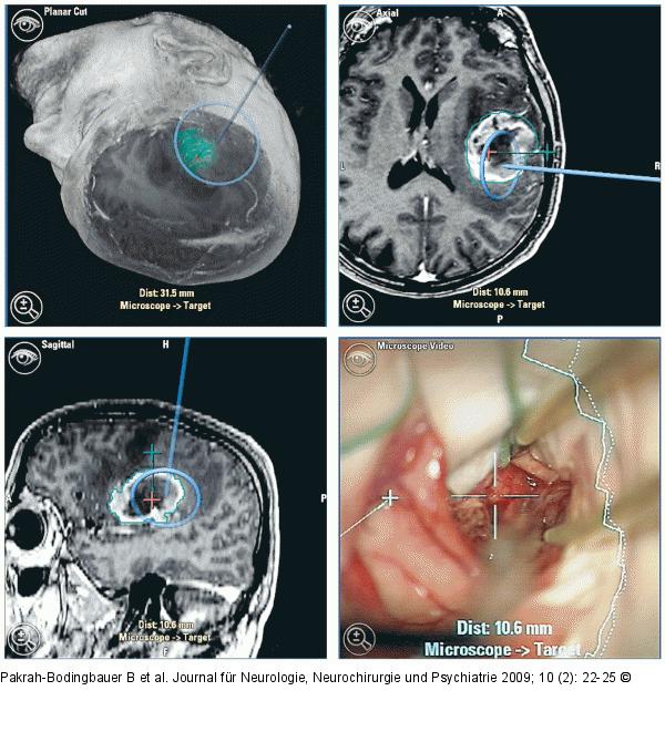 Tumor