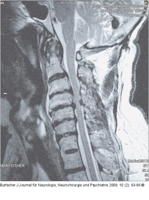 Spinalkanal