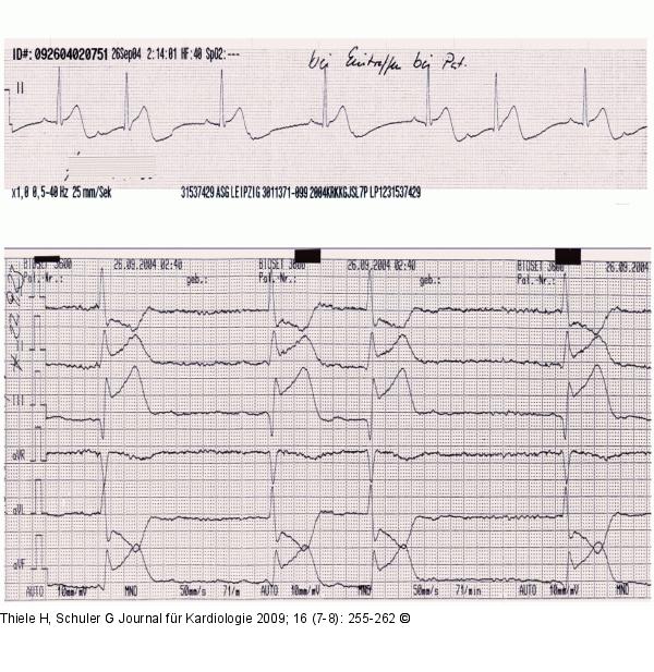 EKG-Beispiel