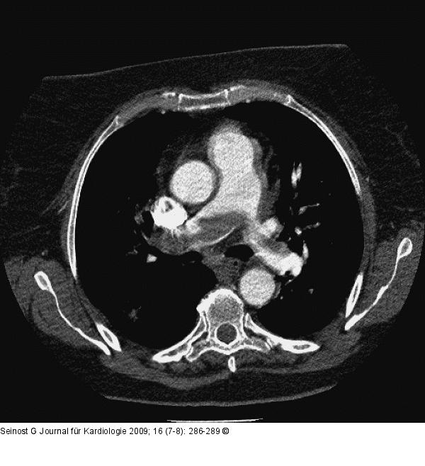 Pulmonalarterienembolie