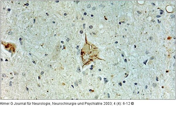 ALS - Neuropathologie