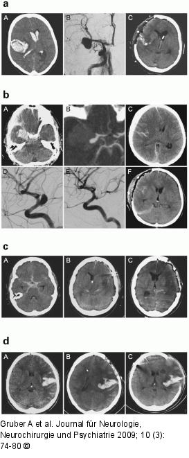 Aneurysmatische Subarachnoidalblutung
