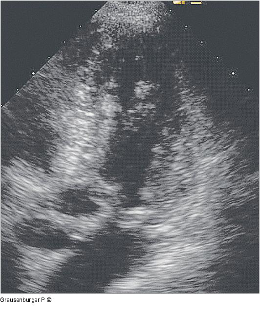 Hypertrophe CMP 