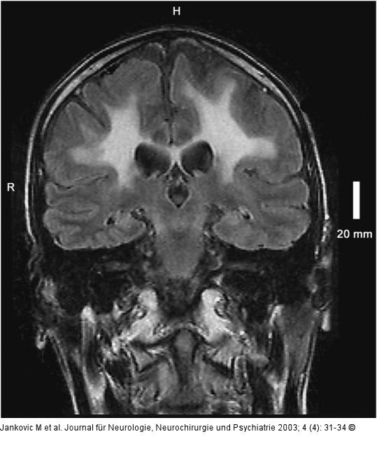 Adrenomyeloneuropathie
