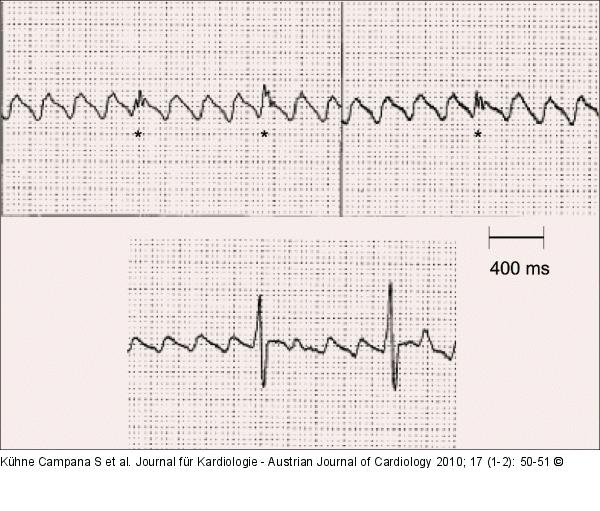 EKG