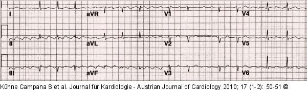 EKG