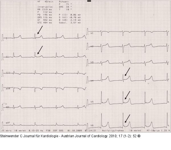 EKG