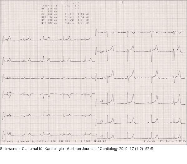 EKG