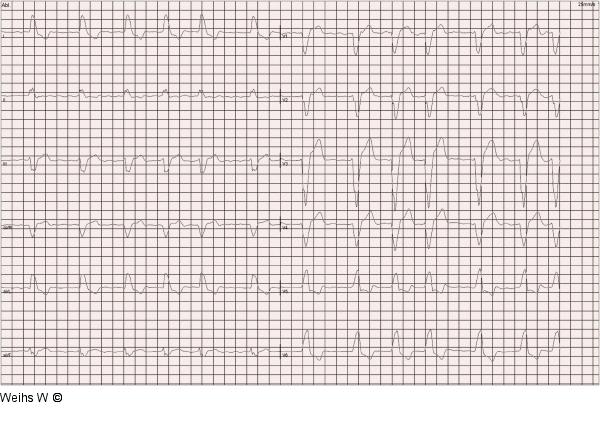 EKG